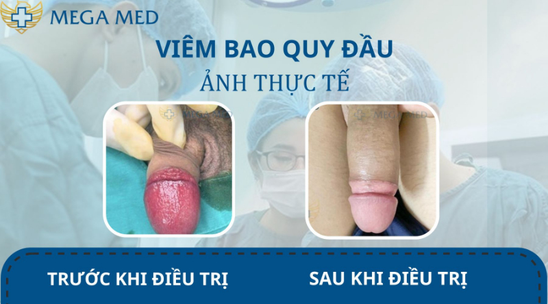 Hình ảnh bao quy đầu bị viêm trước và sau khi điều trị
